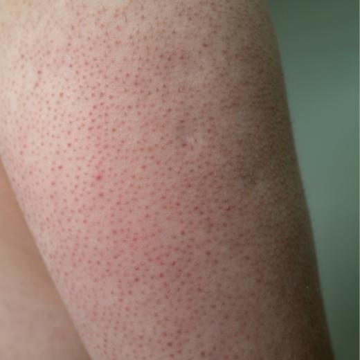 Keratosis Pilaris skin condition on the back of an arm Keratosis Pilaris skin condition on the back of an arm