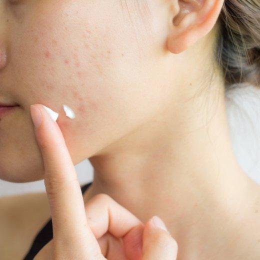 acne face acne face