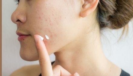 ACNE on face ACNE on face