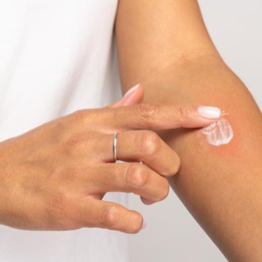 Woman applying moisturizer to her arm with skin irritated by keratosis pilaris Woman applying moisturizer to her arm with skin irritated by keratosis pilaris